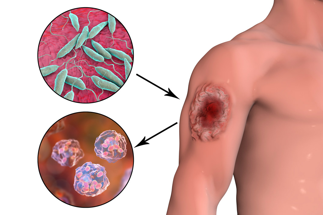 Lee más sobre el artículo Leishmaniasis en Colombia: Qué es, síntomas, tratamiento y derechos de los militares